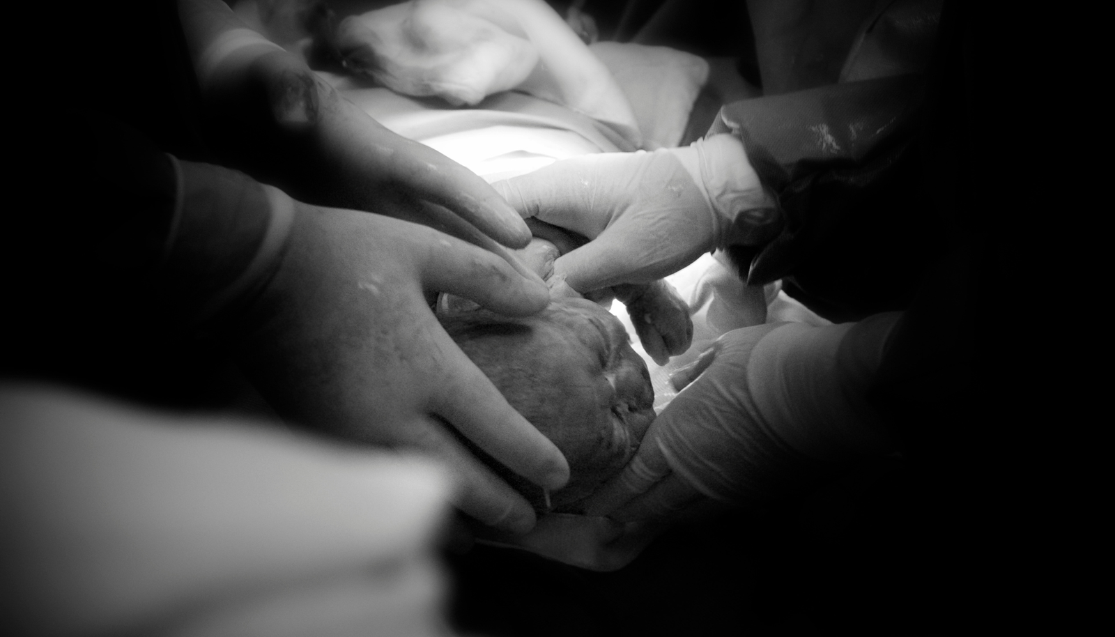 השפעת מספר ניתוחים קיסריים על הריונות עתידיים