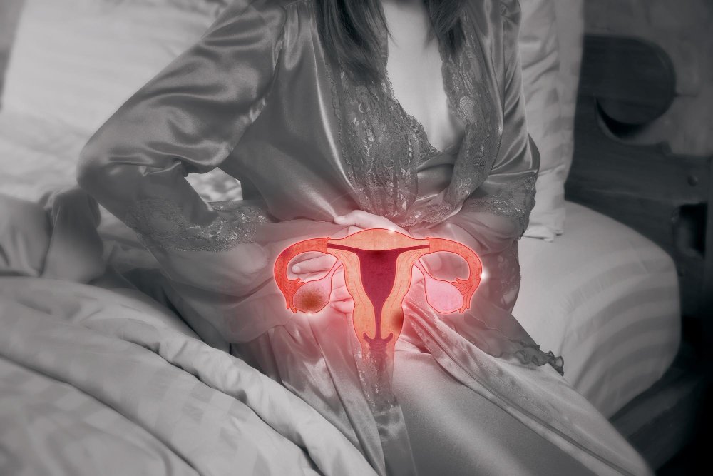 Ovarian cyst